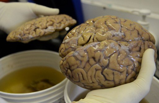 Antioquia University's Neurobanco coordinator Colombian doctor Carlos Villegas, holds a frozen brain at the laboratory in Medellin Antioquia department Colombia