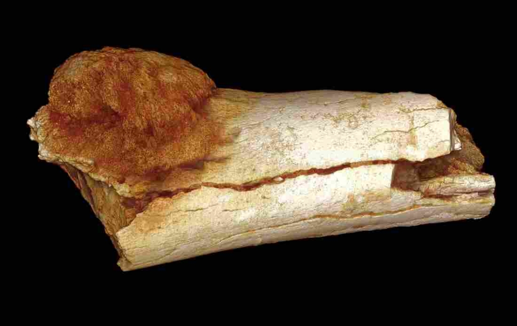 Scientists using a high-resolution X-ray technique found that this bone belonging to a hominin an ancient extinct relative of modern humans has a malignant tumor