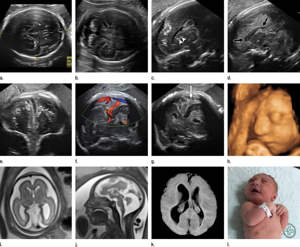 Zika virus can cause catastrophic brain damage if it infects a fetus. RSNA