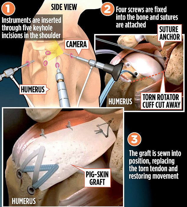 Implant made from pig skin offers minimal scarring and speedy recovery for patients