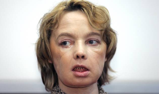 Isabelle Dinoire the woman who received the world's first partial face transplant with a new nose chin and mouth in an operation on Nov. 27 2005 addresses reporters during her first press conference since